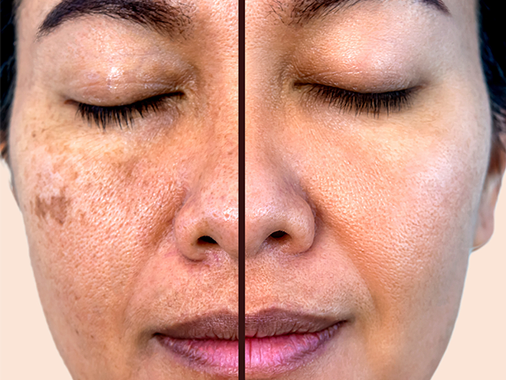 O laser como solução para diminuição das manchas de Melasma.